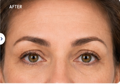 After Botox result