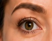 Brow lift