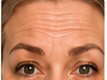 Forehead lines