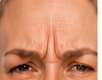 Frown lines