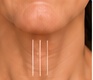 Vertical bands