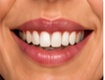 Gummy smile